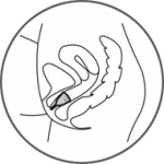Mooncup, coupe menstruelle réutilisable - Insertion